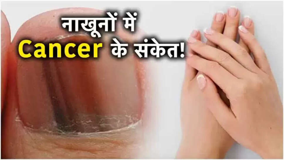 Nail cancer