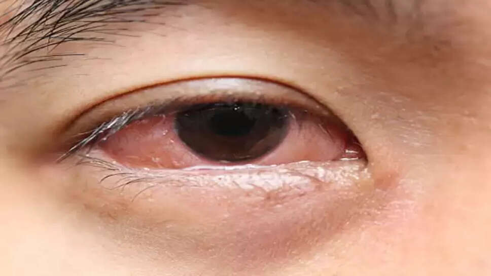 Eye care