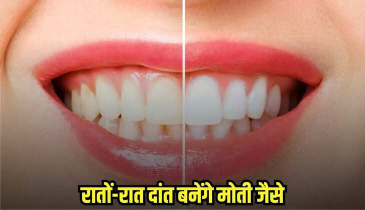 Teeth Whitening Remedy